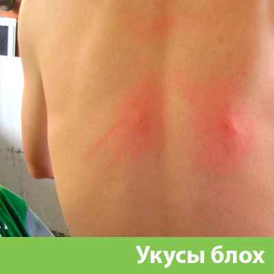 Укусы блох в Клину